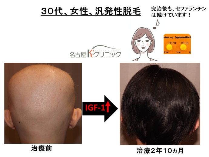 円形脱毛症　病院